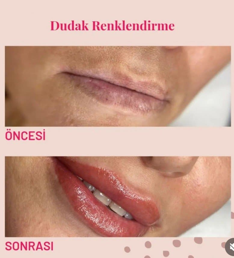 İlknur Ö. — çalışma 1