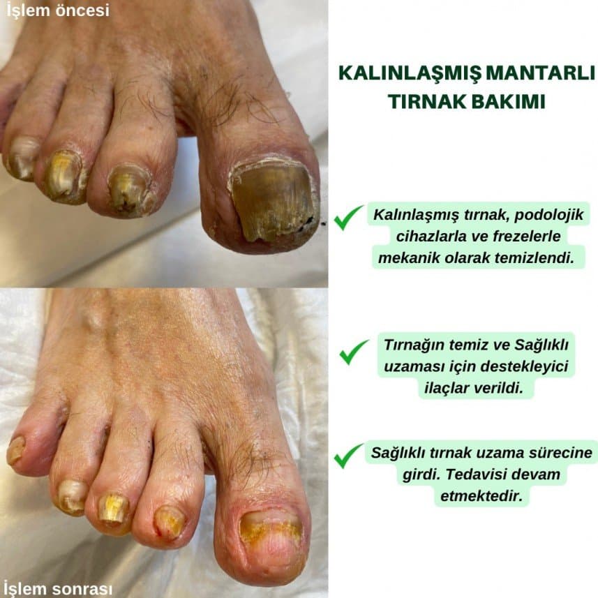 PodoClean — çalışma 3